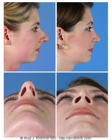Rhinoplasty: Dorsal Hump, Tip, and Nasal Deviation Correction
