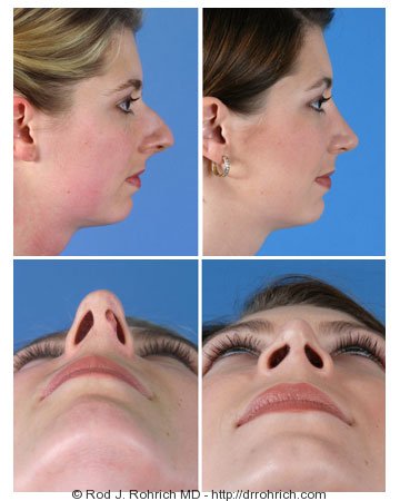 Rhinoplasty Gallery - DrMarkarian