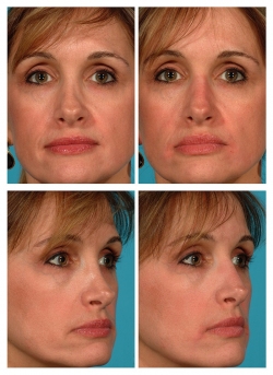 nestemäinen Rhinoplasty