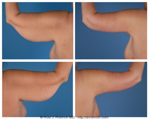 For The Arms – Lipo vs. Brachioplasty