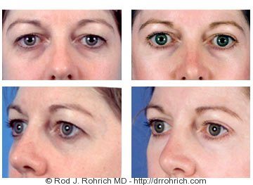 Dallas Eye Lift / Blepharoplasty