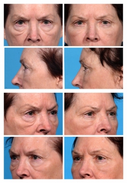 Upper and Lower Eye Lift with Fat Augmentation