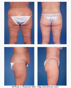 Central Body Lift, Liposuction