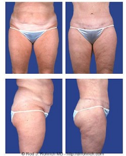 Central Body Lift, Liposuction