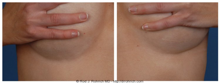 Before and After A to D Cup Breast Augmentation in Dallas, TX, Dr