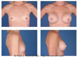 Breast Augmentation: Breast Fold Incision