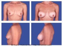 Breast Augmentation: Periareolar Incision