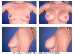 Breast Augmentation: Breast Fold Incision