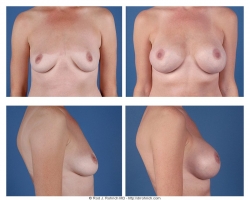 Breast Augmentation: Saline, Smooth, Round