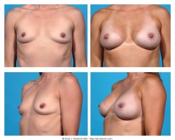 Breast Augmentation: Saline, Smooth, Round