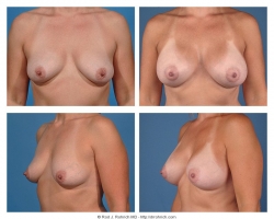 Breast Augmentation: Silicone Gel, Smooth, Round