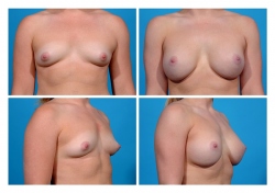 Breast Augmentation: Silicone Gel