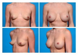 Breast Augmentation: Silicone Gel