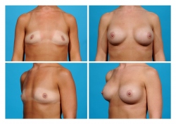 Breast Augmentation: Saline