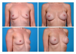 Breast Augmentation: Saline
