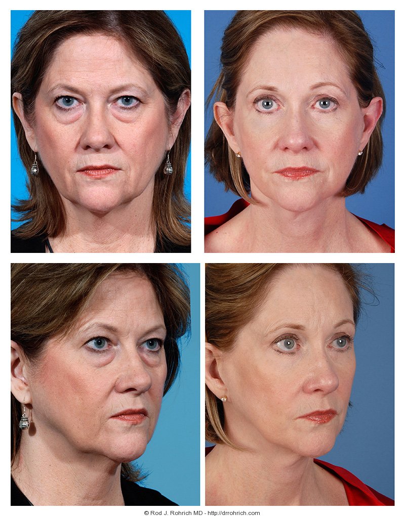 Dr. Rohrich Facelift Before and After Photos