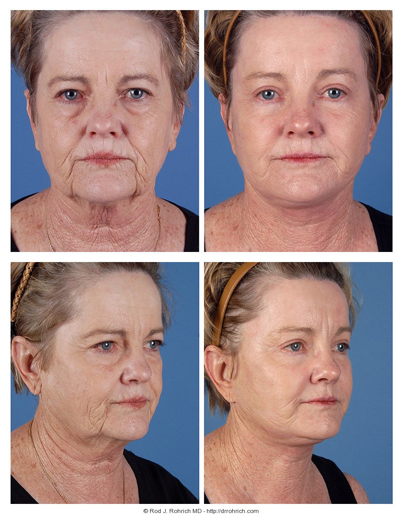 Dallas Facelift Before and After Photos
