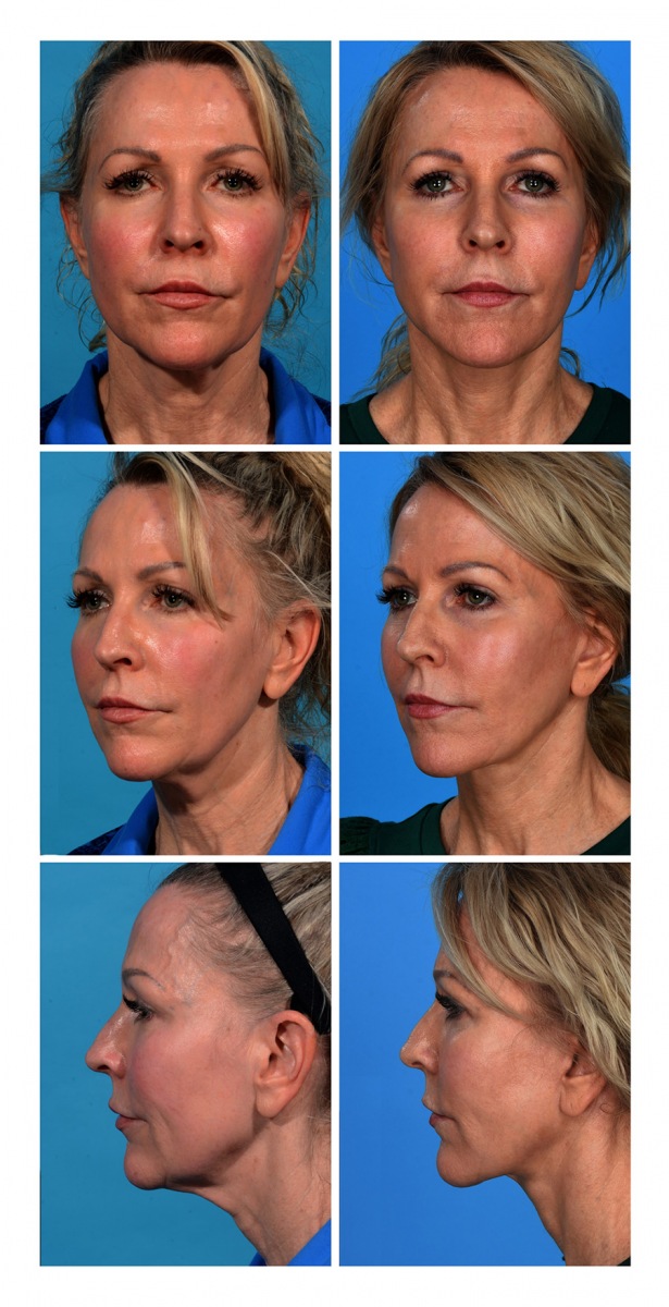Dallas Facelift Before and After Photos