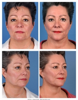 Facelift, Upper and Lower Eyelids, Fat Injections