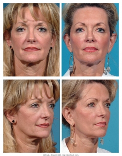 Facelift, Upper and Lower Eyelids, Fat Injections