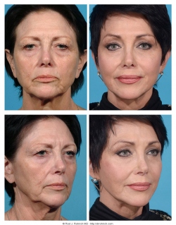 Facelift, Brow Lift, Upper and Lower Eyelids, Chemical Peel