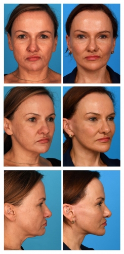 Facelift, Fat Grafting, Buccal Fat Removal, Browlift