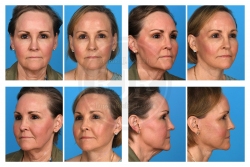 Lower Facelift, Necklift, Derbabrasion Neck Scar, Fat Augmentation: Face, Eyelids, Temporal Area