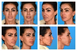 Facelift, Necklift, Open Rhinoplasty, Facial Fat Augmentation, Nasal Scar Excision and Dermabrasion, Full Face Botox