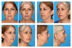 Facelift, Necklift, Upper and Lower Blepharoplasty, Fat Augmentation, 35% TCA Chemical Perioral Peel