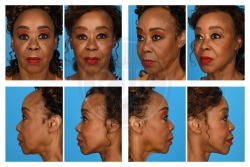 Deep Layer Facelift with Upper Eyelid Surgery and Fat Grafting