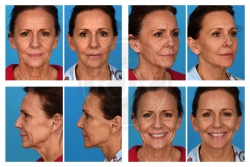 Full Facial Rejuvenation with Facelift, Brow Lift, and Eyelid Surgery Full Facial Rejuvenation with Facelift, Brow Lift, and Eyelid Surgery