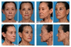 Comprehensive Facial Rejuvenation with Deep Plane Facelift and Fat Grafting Comprehensive Facial Rejuvenation with Deep Plane Facelift and Fat Grafting