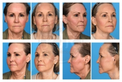 Lower Facelift, Necklift, and Facial Fat Augmentation for Rejuvenation