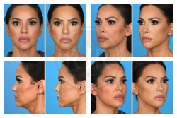 Lower Face and Neck Lift with Upper Blepharoplasty and Fat Augmentation