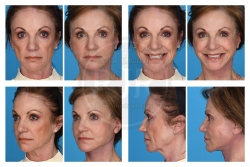 Deep Layer Facelift with Eye Rejuvenation & Targeted Fat Grafting