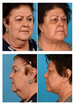 Face Contouring / Necklift with Liposuction