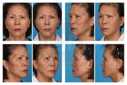 Secondary Facelift with Upper Eyelid Surgery and Fat Grafting