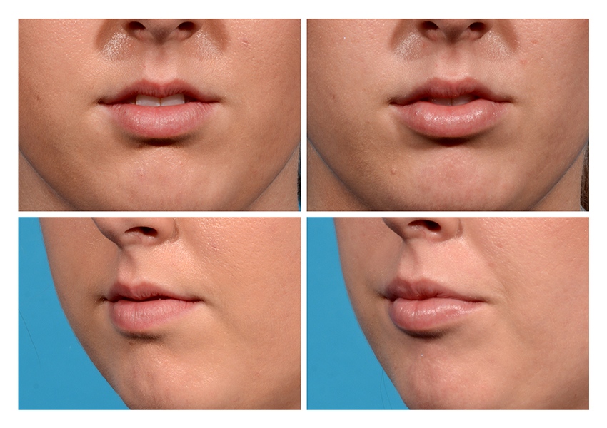 Lip Augmentation: Juvederm