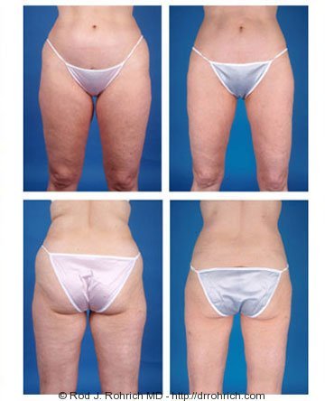 Liposuction of Flanks Before and After 3804