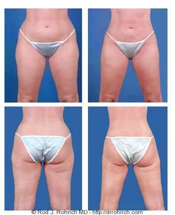 Before & After Tummy tuck with lipo to flanks and thighs - Dr