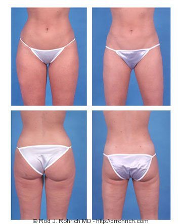 Liposuction of Flanks Before and After 3804