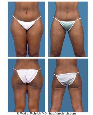 Liposuction - Inner and/or Outer Thighs Before and After Photo