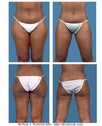 Liposuction - Abdomen / Flanks Before and After Photo Gallery, Coeur  d'Alene, ID