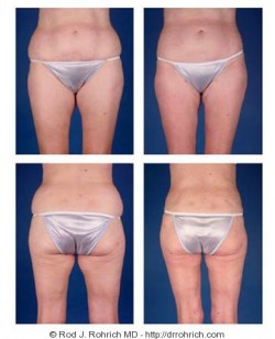 Liposuction: Flanks and Thighs