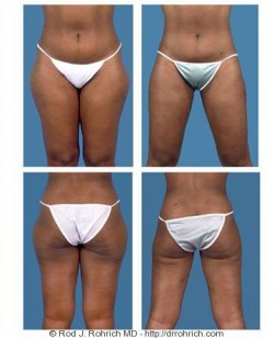 Liposuction: Flanks and Thighs