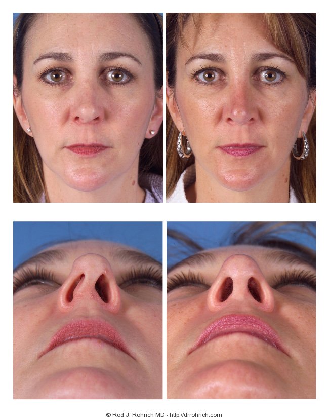 Dr. Rohrich Revision Rhinoplasty Before and After Photos