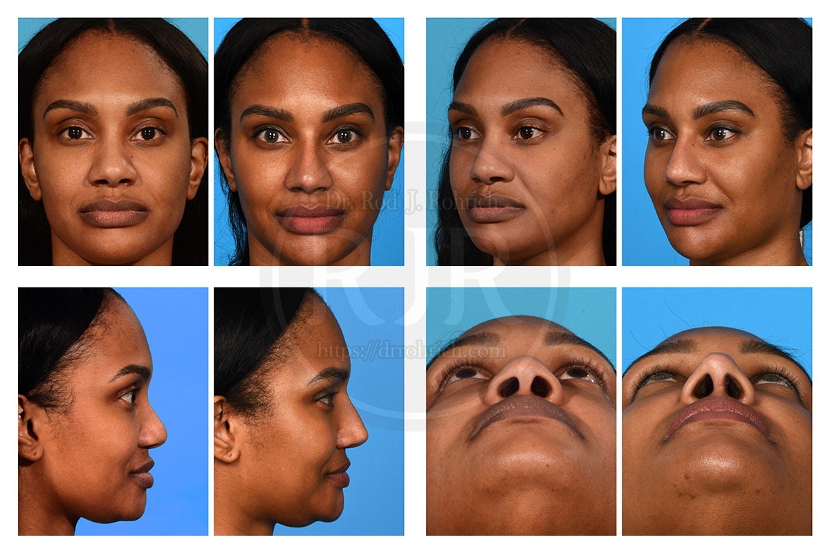 Revision Rhinoplasty Before and After Photos