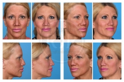 Secondary Rhinoplasty with MTF Graft
