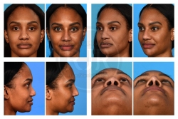 Revision Rhinoplasty: Alar Base Resection