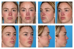 Tertiary Rhinoplasty with MTF Graft – Nine Months Post-Op